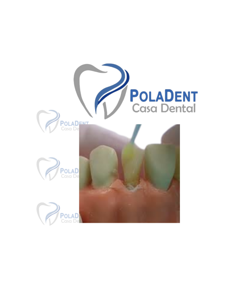 Acido grabador. Coltene - Imagen 3